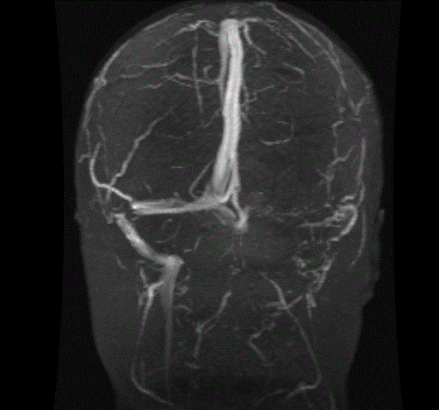venography