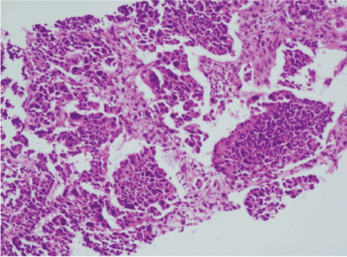 carcinoma