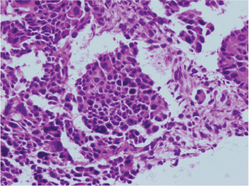 neuroendocrine