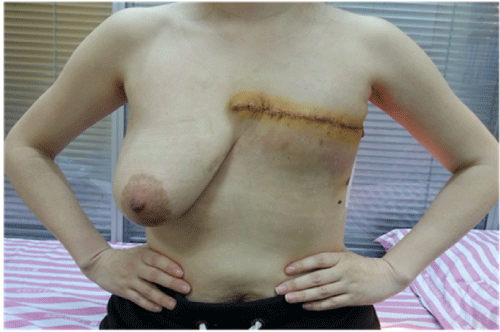 Postoperative