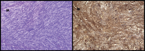 Fibrosarcoma