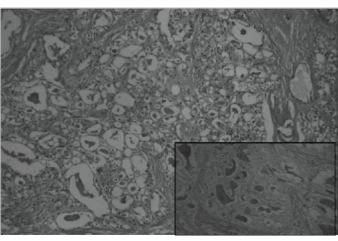 Microcystic