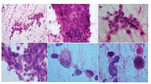 Chordoma