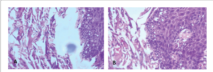 dysplastic