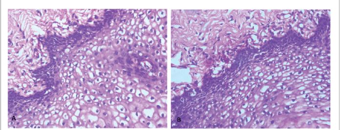 koilocytosis