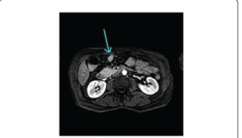 peritoneal