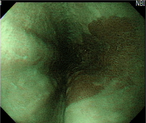 mucosa