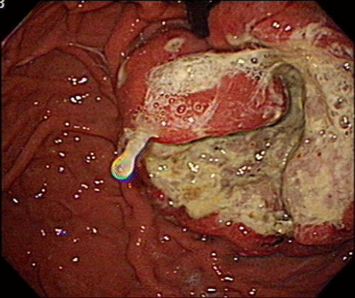 tumor