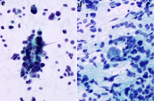 neuroblastic