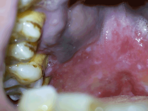 erythematous