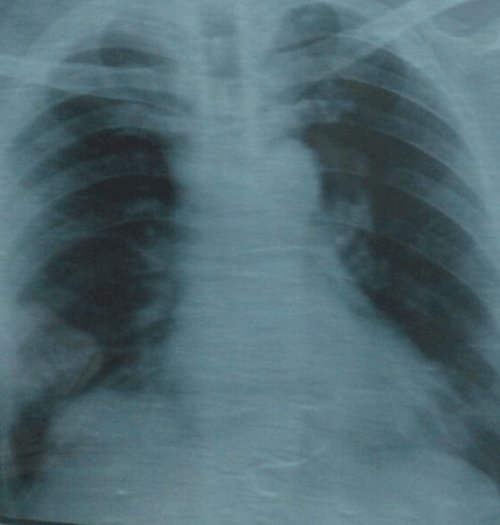 mediastenal