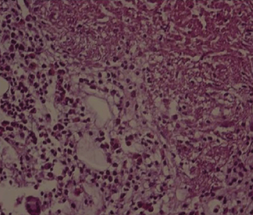 granulomas
