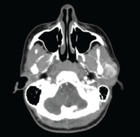 preauricular