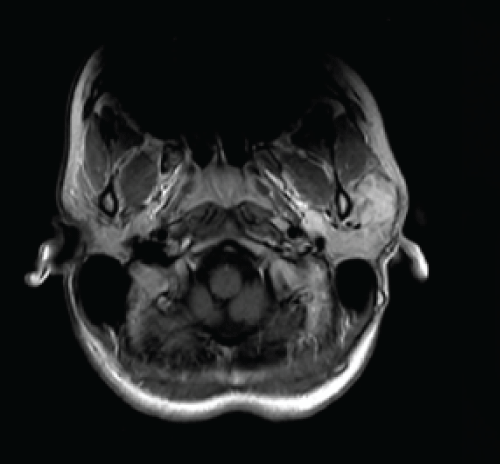 parotid