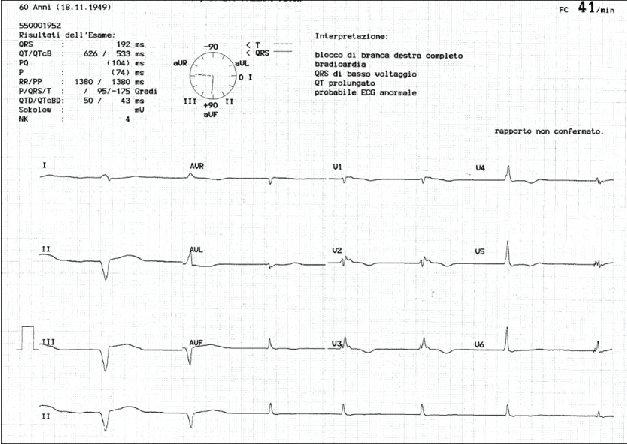 fibrillation