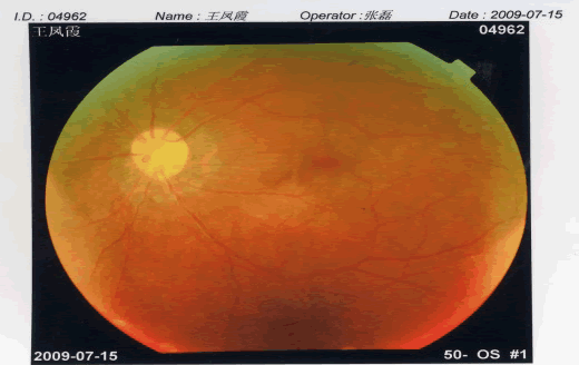 Funduscopic