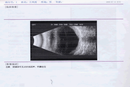 Ocular