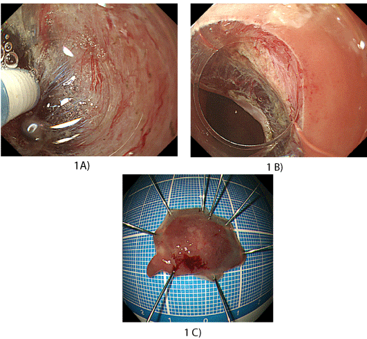 Endoscopic