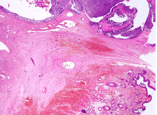 adenocarcinoma