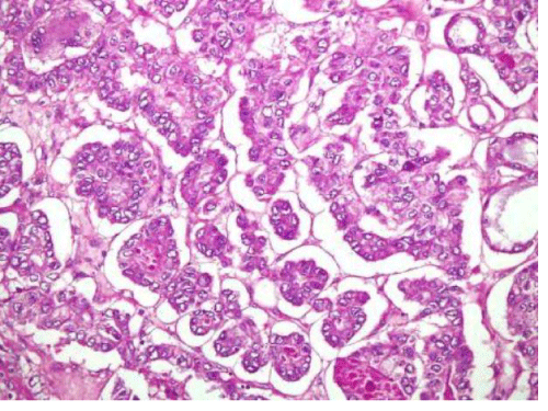 papillary