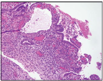 endometriosis