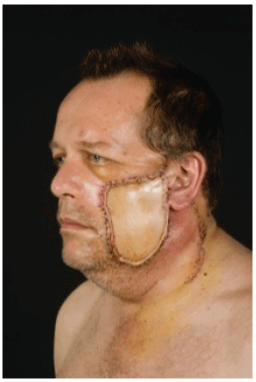 resection