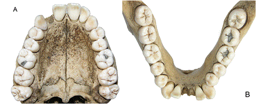 Occlusal