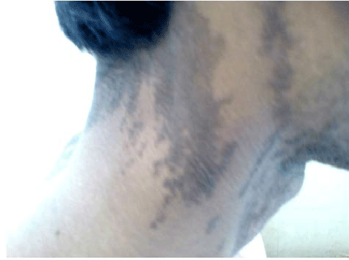 Epidermal
