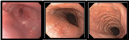 Endoscopic