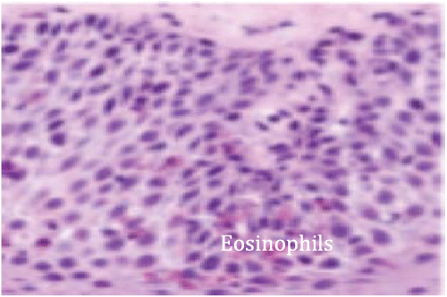 Endoscopic