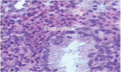 Eosinophils