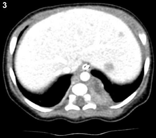 abdominal