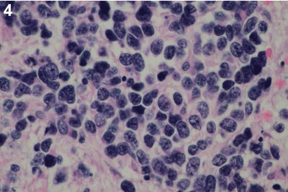 biopsy