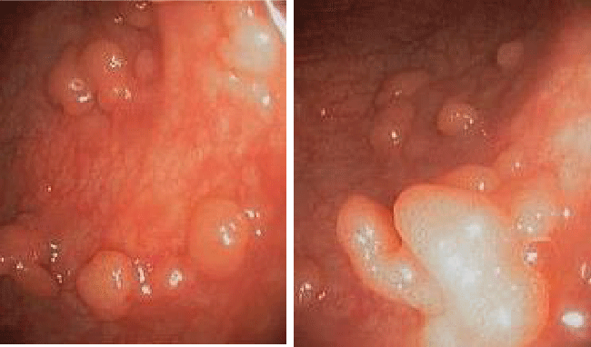Colonic