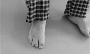 Syndactyly