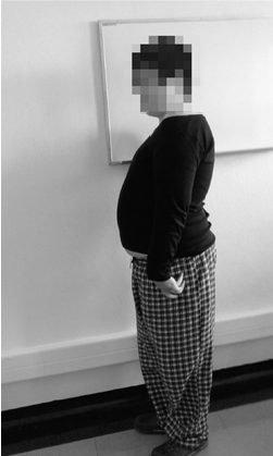 Scoliosis