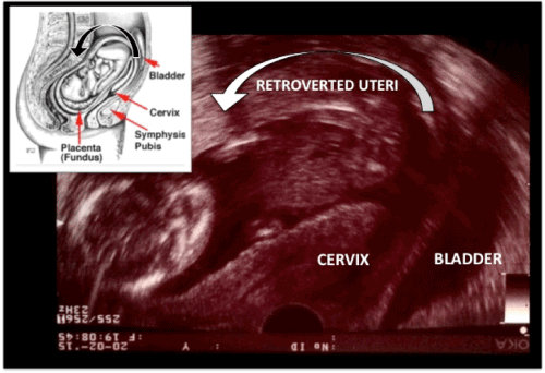 Transvaginal