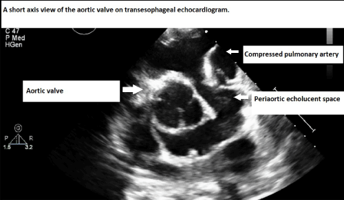 transesophageal