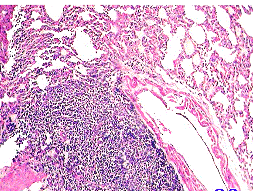 peribronchial