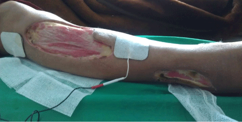 physiotherapy
