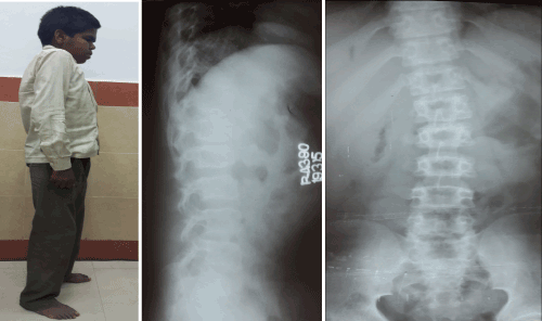 scoliosis