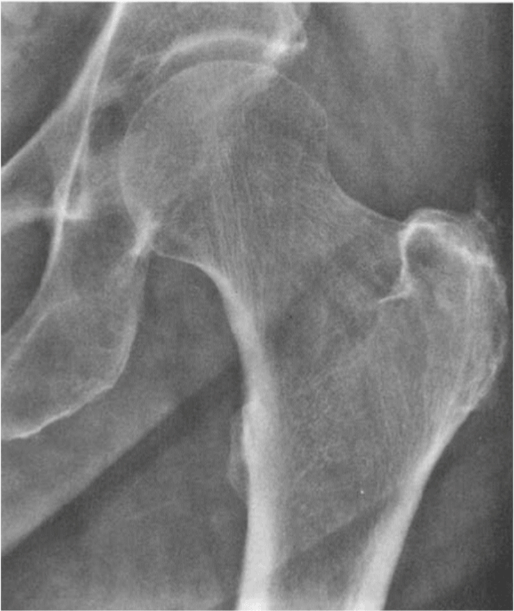 Trochanteritis x ray