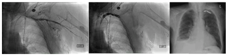 subclavian
