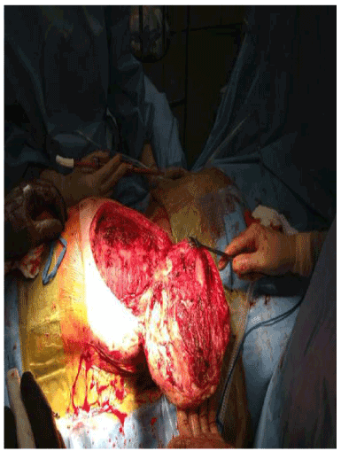 incision