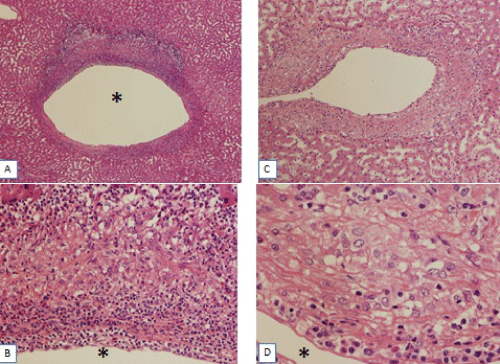 Granulomatous
