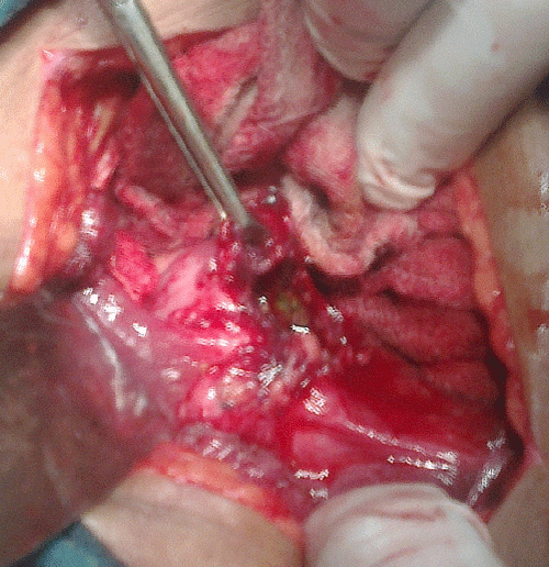 Gross