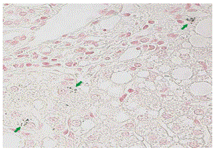 biopsy
