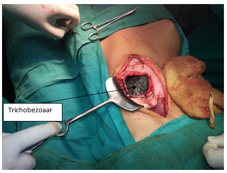 Gastrotomy