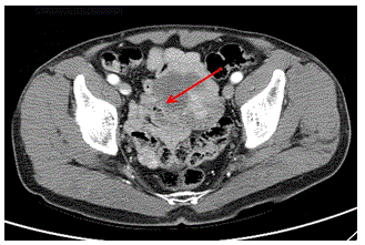 abdominal