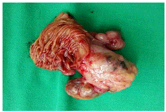 Resected